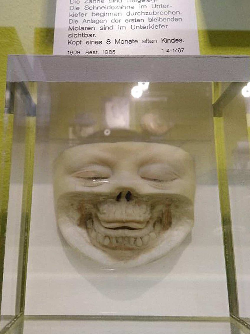 Aossi skull replica in a display case with medical or educational context.